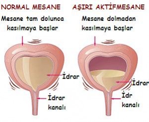 asırıaktifmesane[1]