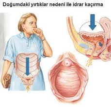 idrarkacirma3