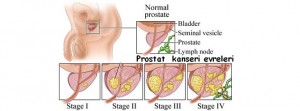 prostat-kanseri-