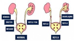 vezikoüreteralreflü